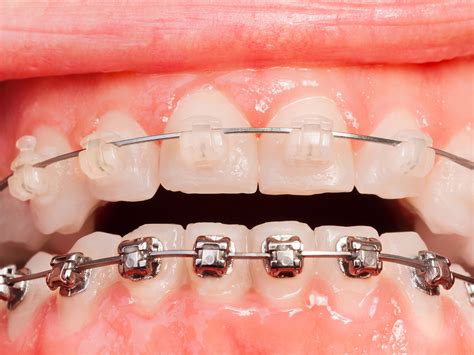 metal brackets vs ceramic brackets|problems with ceramic braces.